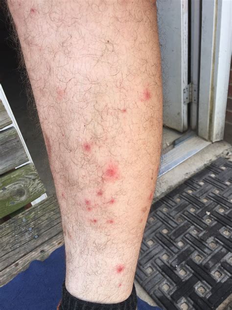Scabies Rash On Thighs