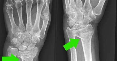 Osteoporosis Case Study 2 Radius Wrist Fracture