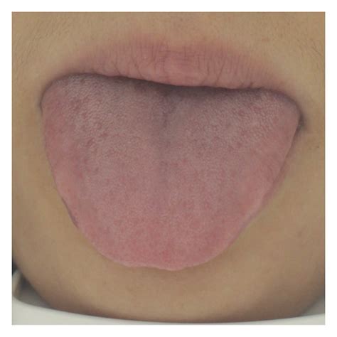 Different Tongue Fur Thickness Groups A Thin Tongue Fur Normal