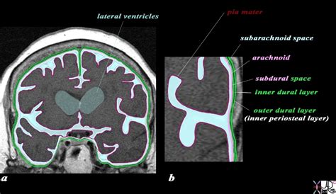 Subarachnoid Hemorrhage Brain