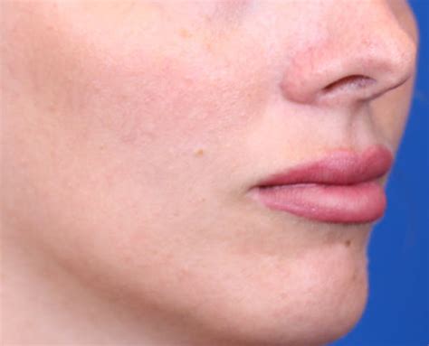 Patient 24802629 Permalip Lip Implants Before And After Photos
