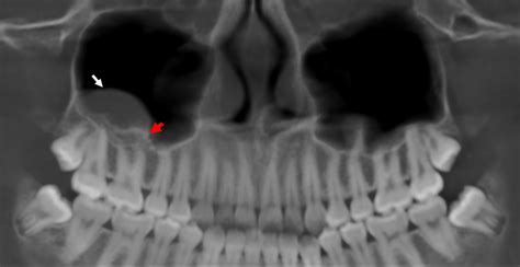 Antrolitos En El Seno Maxilar Derecho Dento Metric Radiología