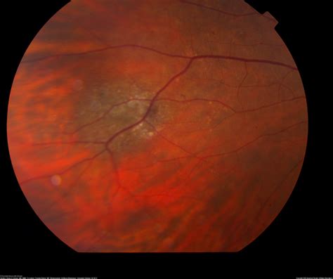Choroidal Nevus Annan Retina Eye Center In Houston Texas