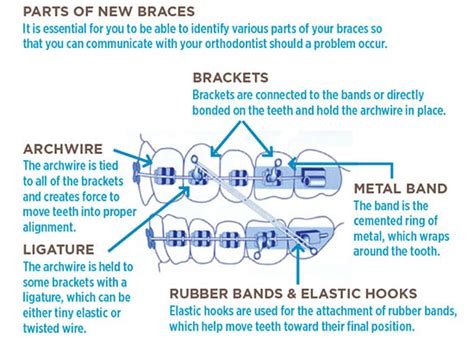 Braces Wires Brackets And Spacer Problems At Home Solutions