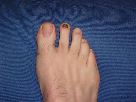 Purple Toenail Ok I Know Its Gross But My Second Toenai Flickr