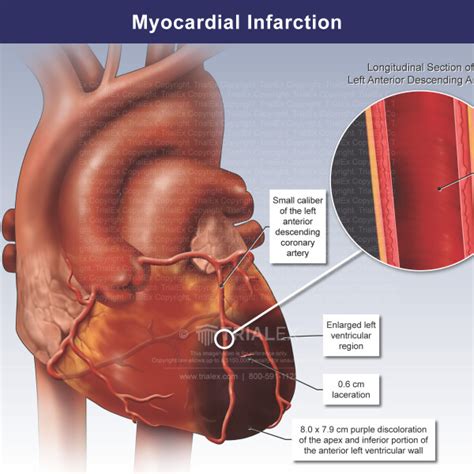 Apical Myocardial Infarct Heart Attack Trial Exhibits Inc
