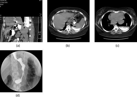 Gastropleural Fistula Due To Leak A Coronal Reconstructed Ct Image