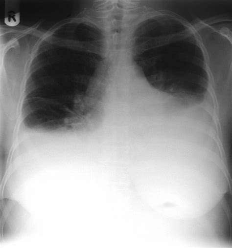 A 66 Year Old Woman With Breathlessness Case Presentation The Bmj