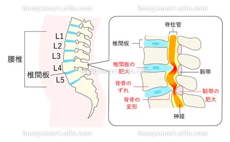 脊柱管狭窄症になった腰椎の説明イラスト拡大図 214991036 イメージマート