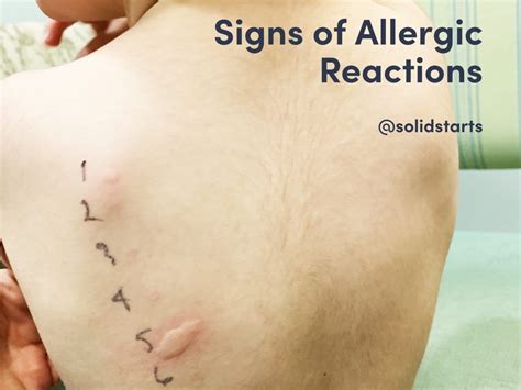 Allergic Reactions To Food Typically Occur Within 2 Hours Of Consuming
