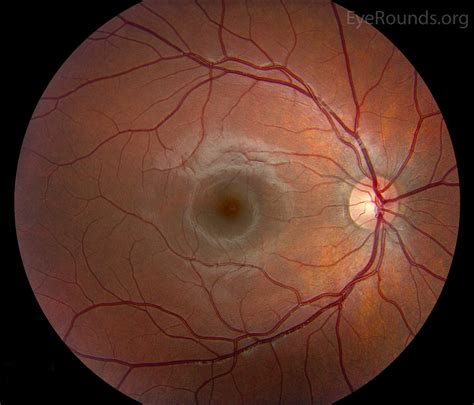 Atlas Entry Normal Fundus Child