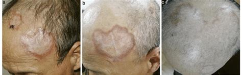A Multiple Erythematous Plaques With Raised Borders And Atrophic