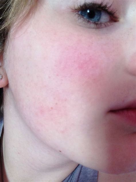 What Do I Use Or How To Get Rid Of The Redness And The Bumps I