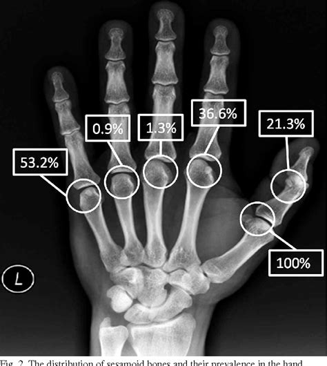Figure 2 From Prevalence And Distribution Of Sesamoid Bones Of The Hand