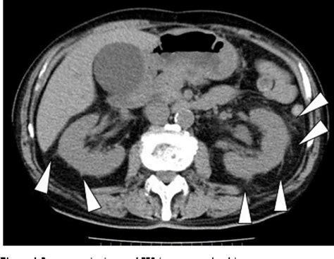 Figure 1 From Perirenal Fat Stranding Is Not A Powerful Diagnostic Tool