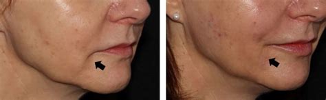 How To Tighten Skin Around Lips Lipstutorial Org