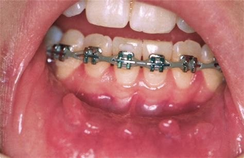What To Do When You Get Mouth Sores With Braces Schmitt Orthodontics