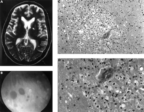Microangiopathy Of The Brain And Retina With Hearing Loss In A 50 Year