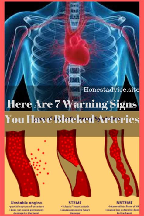 Here Are 7 Warning Signs You Have Blocked Arteries Bad Circulation In