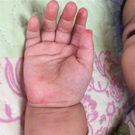 Baby Contracted Hand Foot Mouth Disease From Sitting In A Baby Chair