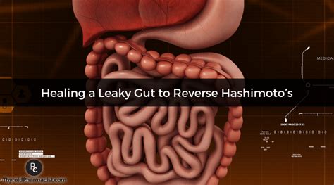 Healing A Leaky Gut And Hashimotos Dr Izabella Wentz