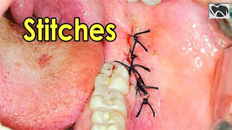 In the case the vets use dissolvable stitches (which dissolve over time), removal is unnecessary. What Color Are Dissolvable Stitches In Mouth | Colorpaints.co