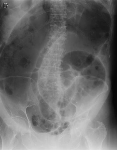 Sigmoid Volvulus Radiology Case Radiology