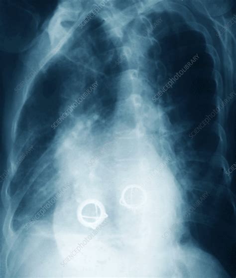 Prosthetic Heart Valves X Ray Stock Image M5610093 Science