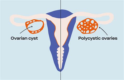 Pregnancy With Ovarian Cysts And Polycystic Ovarian Syndrome Bridge