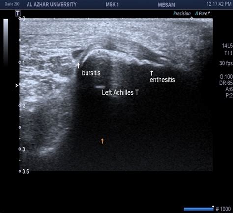 Longitudinal Scan Of The Achilles Tendon Showing Enthesitis In A Male