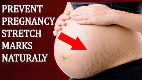 Best Natural Way To Prevent Stretch Marks During Pregnancy Youtube