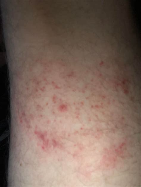 I Posted Here 2 Days Ago For A Potential Lyme Rash After 2 Days Of