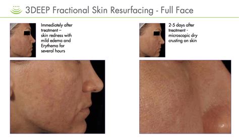 Endymed Fractional Skin Resurfacing At Cheshire Lasers Middlewich