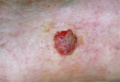 Squamous Cell Cancer Of Skin On Leg Photograph By Dr P Marazziscience