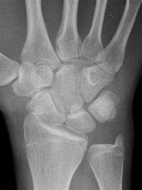 Scaphoid And Capitate Fracture Image