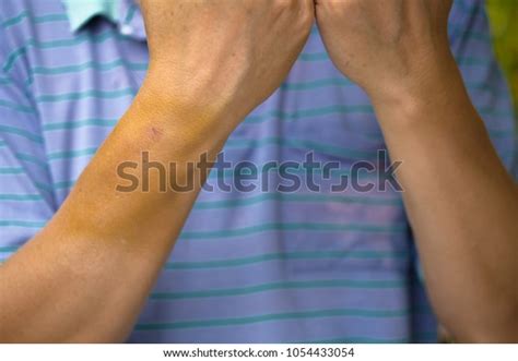 Large Bruise Forearm Injection Bruises Stock Photo 1054433054