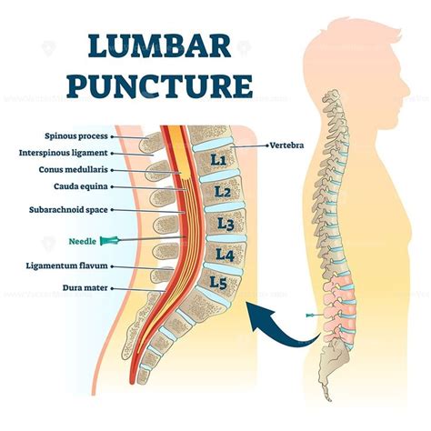 Lumbar Puncture Vector Illustration In 2020 Lumbar Puncture Vector