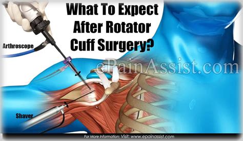 Bicep Pain After Rotator Cuff Surgery Core Plastic Surgery