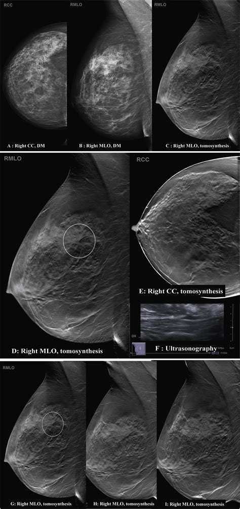 Digital Breast Tomosynthesis 3d Mammography Screening A Pictorial