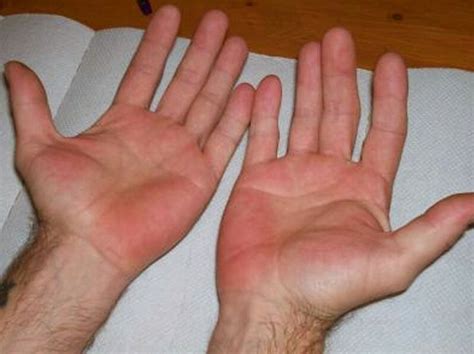 Pinterest Red Palm Hyperhydrosis Hands Hand Health
