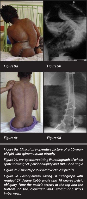 Neuromuscular Scoliosis Surgical Management And Outcomes