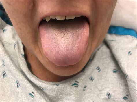 I thank you from the bottom of. Black hairy tongue: What is it, and how do you get it