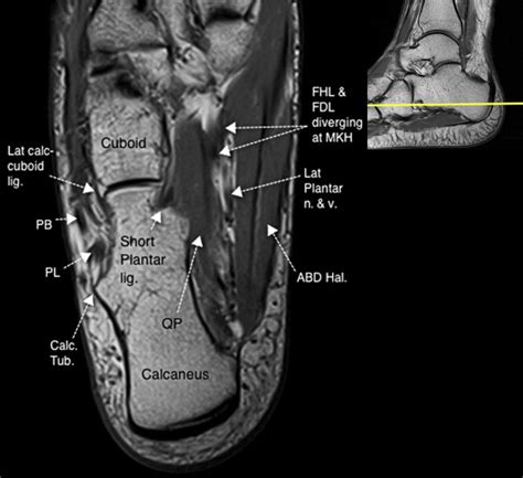 Normal Magnetic Resonance Imaging Anatomy Of The Ankle And Foot