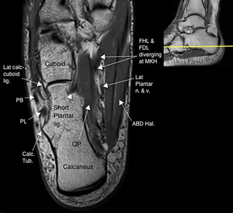 The intrinsic muscles of the foot are designed to provide your toes with as much dexterity as your fingers. Normal Magnetic Resonance Imaging Anatomy of the Ankle & Foot - Magnetic Resonance Imaging Clinics