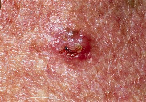 Basal Cell Carcinoma On A 78 Year Old Mans Skin Stock Image M131