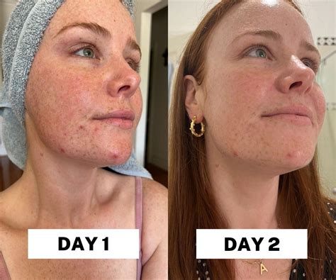Salicylic Acid Before And After