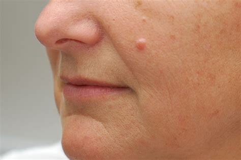 Moles Warts Skin Tags And Benign Growth Treatment Options