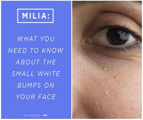 Tiny White Bumps On Skin What Are Milia Powered By L