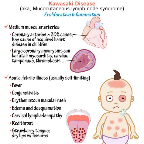 Kawasaki Infection 🌈kawasaki Disease In Children Symptoms Causes