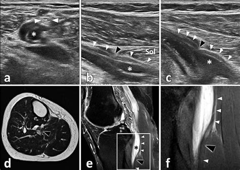 Axial Hrus Imaging A Of The Tibial Nerve Demonstrates A Part Of The
